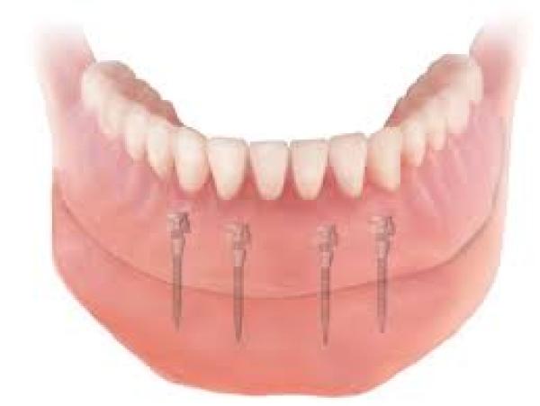 Mini Dental Implants