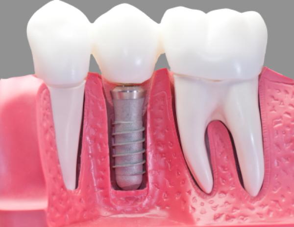 What is dental implant?